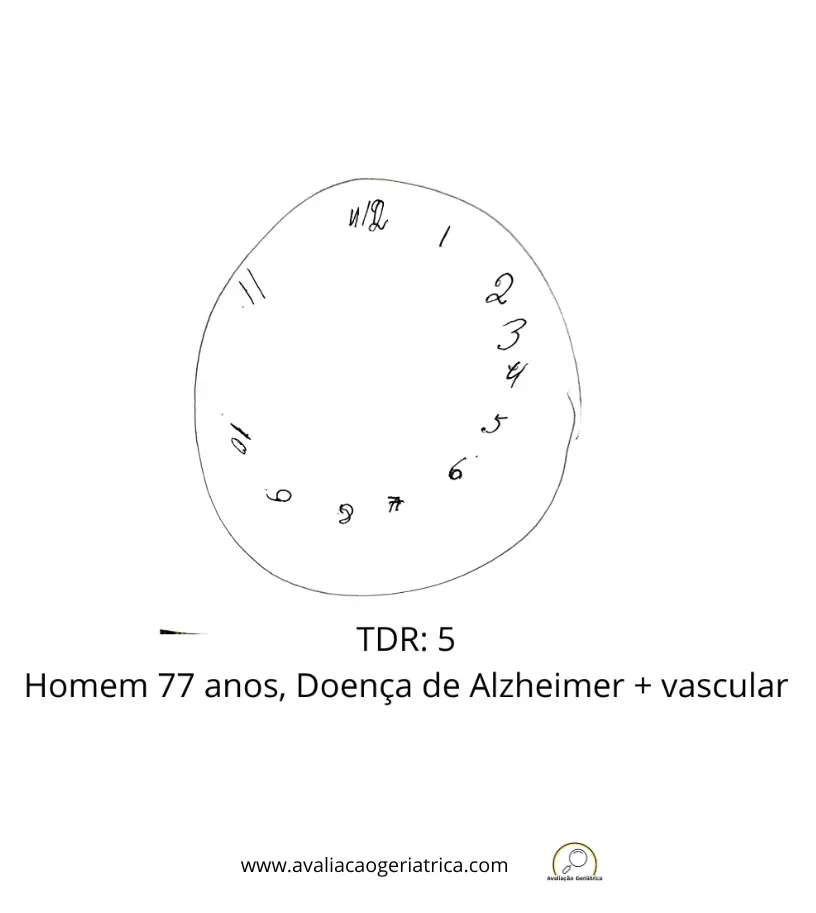 Exemplo teste do desenho do relógio: 5 pontos (Sunderland): Homem 77 anos - Doença de Alzheimer + demência vascular