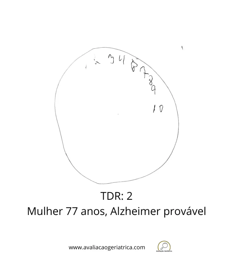Exemplo teste do desenho do relógio: 2 pontos (Sunderland): Mulher 7 anos - Doença de Alzheimer provável